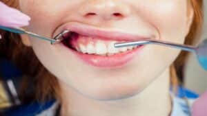 Simple Tips To Prevent Receding Gums & Improve Teeth Health